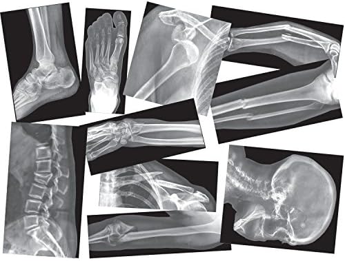 Roylco Kırık Kemikler Röntgen Seti, Projektör Ekranı Uyumlu, 15 Röntgen