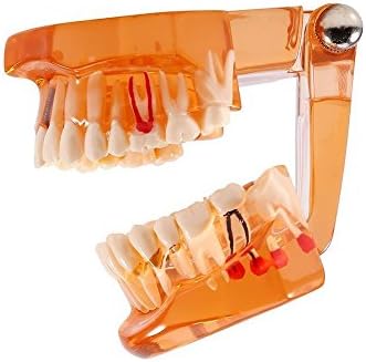 DR. BEYAZ Diş Diş Modeli Turuncu, Şeffaf Diş İmplant Hastalığı Diş Modeli Diş Hekimi Standart Patolojik Çıkarılabilir Diş Öğretim